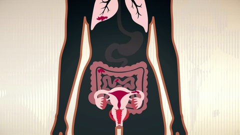 Endometriose-Herde im Körper
