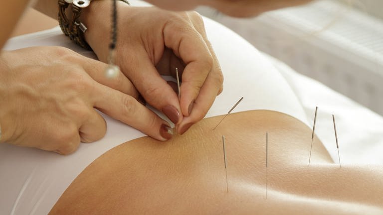 Eine Frau setzt Akupunkturnadeln in den Rücken einer Frau. Diese liegt mit dem Bauch auf einer Liege.