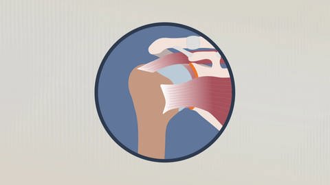 Abbildung der Rotatorenmanschette, eine Struktur aus Muskeln und Sehnen, die das Schultergelenk kappenartig umfasst.