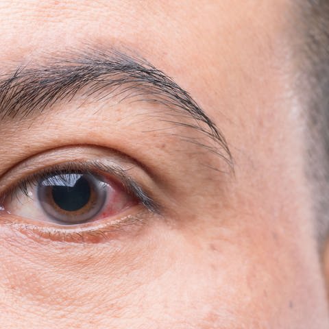 Mann mit gerötetem Auge (Foto: Colourbox)