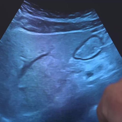 Ultraschallbild von einem Magen (Foto: SWR)