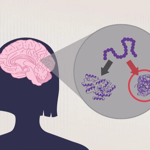Grafik veränderte Gehirnregionen bei Parkinson