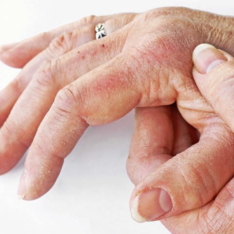 Eine Hand wird von einer anderen am Fingergrundgeleng massiert (Foto: IMAGO, imago0164371395h)