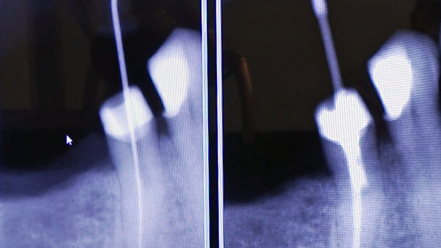 Röntgenbild Zahnwurzel (Foto: SWR)