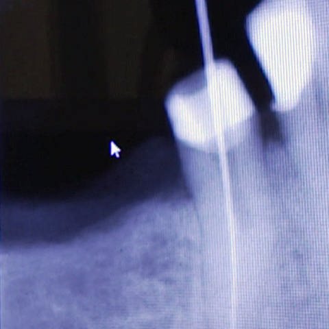 Röntgenbild Zahnwurzel (Foto: SWR)