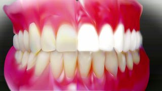 Beim Bleaching werden mittels Chemie Zähne weißer (Foto: SWR)