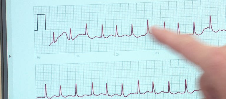 EKG - Diagramm, Arzt zeigt auf Impuls-Spitzen in der Messung (Foto: SWR)