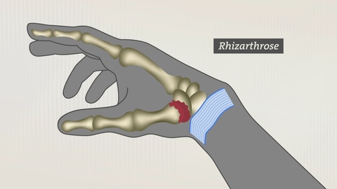 Rhizarthrose: Hier verursacht das Daumensattelgelenk Schmerzen in der Hand (Foto: SWR)