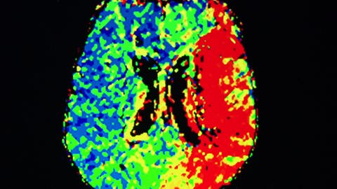 Computertomografie des Gehirns - Schlaganfall, rechtseitig (Foto: SWR)