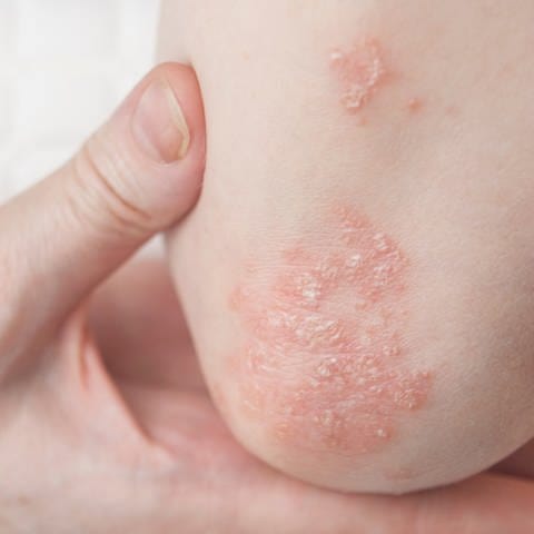 Schuppenflechte, auch Psoriasis genannt, ist eine Autoimmunerkrankung (Foto: AdobeStock, 497220254)