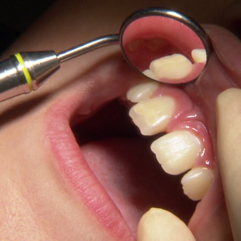 geöffneter Mund beim Zahnarzt (Foto: SWR, SWR -)