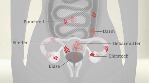 Chronische Krankheit Endometriose: Zellen, die denen der Gebärmutterschleimhaut (Endometrium) ähneln, siedeln sich außerhalb der Gebärmutter an  (Foto: SWR)