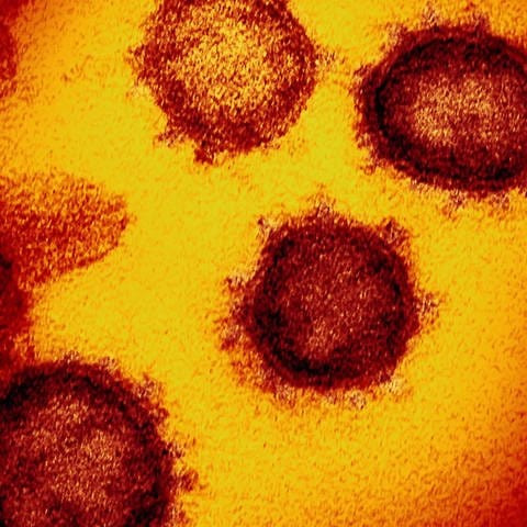 Coronavirus - Darstellung mit Elektronenrastermikroskop, Präparat rot-gelb dargestellt (Foto: SWR)
