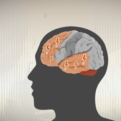 Ein menschlicher Kopf mit stilisiertem Gehirn. Rote Pfeile in einigen Hirnarealen sollen einen stattgefundenen Schlaganfall markieren.