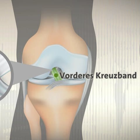 Grafik, die anzeigt, wo das Kreuzband im Knie verläuft. Wird das Knie falsch belastet, kann das Kreuzband reißen.