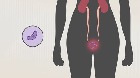 Abbildung des Unterleibs einer Frau. Bakterien befinden sich in der Blase. (Foto: SWR)