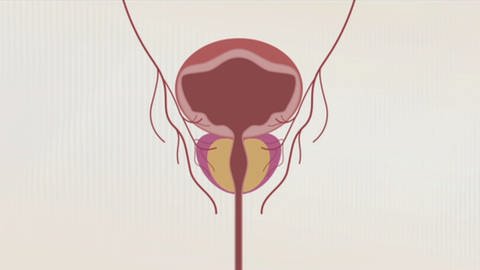 Schaubild einer normalen Prostata mit offenem Harngang. Gutartige Prostatavergrößerung: So kann man sie behandeln (Foto: SWR)