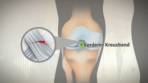Grafik, die anzeigt, wo das Kreuzband im Knie verläuft. Wird das Knie falsch belastet, kann das Kreuzband reißen. (Foto: SWR, Picture Alliance)