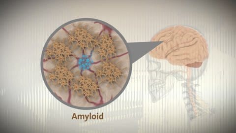 amyloid skizze (Foto: SWR)