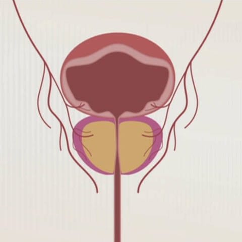 Schaubild einer vergrößerten Prostata mit verengter Harnröhre. Gutartige Prostatavergrößerung: So kann man sie behandeln. (Foto: SWR)