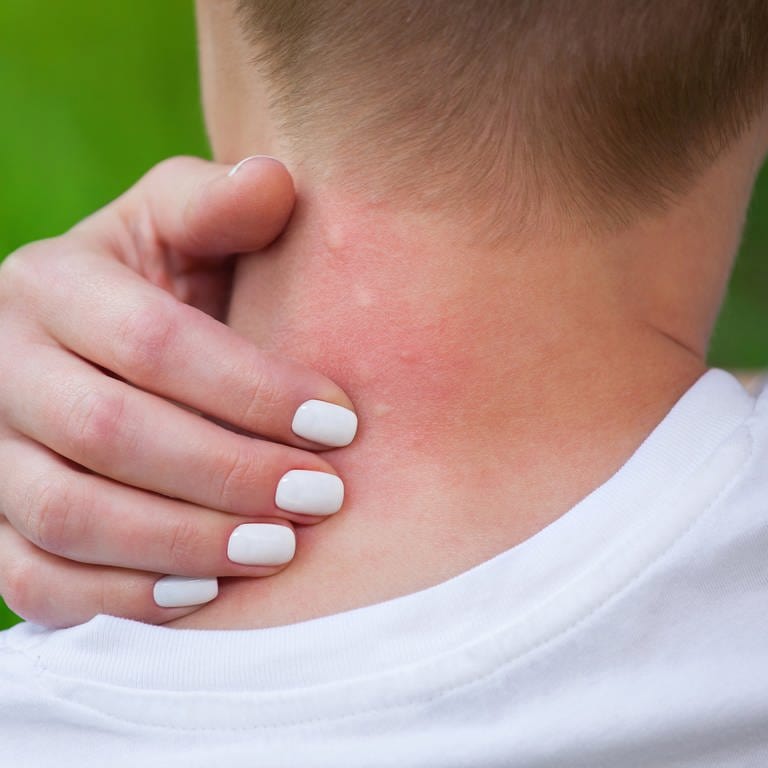 Frau kratzt sich an Mückenstichen im Nacken (Foto: Colourbox)