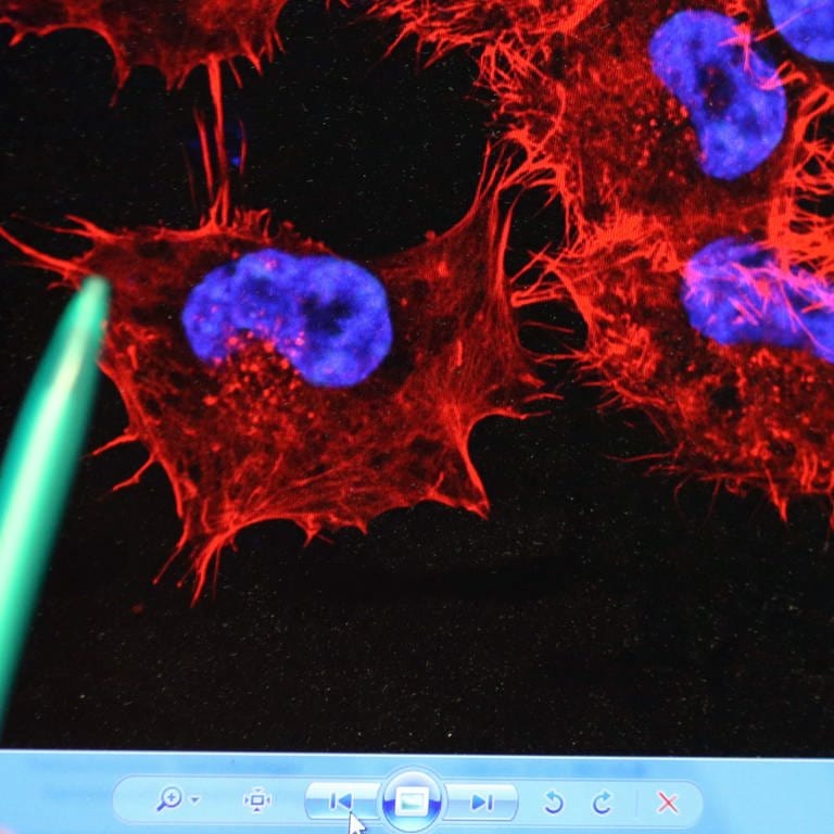 Hand zeigt auf Zellen-Wucherung durch Hautkrebs auf Computerbildschirm