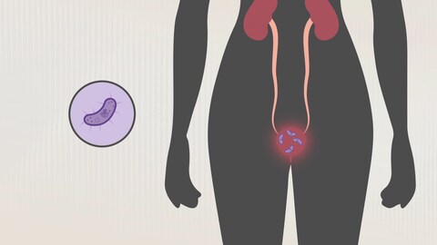 Abbildung des Unterleibs einer Frau. Bakterien befinden sich in der Blase.