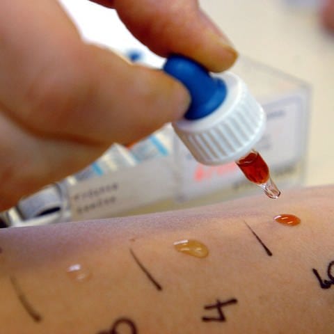 Bei einem Allergie-Test werden Substanzen auf die Haut einer Patientin aufgetragen. (Foto: SWR)
