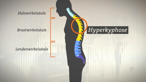 Grafik einer Person mit eingezeichneter Wirbelsäule. Beschriftung: Halswirbelsäule (oben), Brustwirbelsäule (mitte), Lendenwirbelsäule (unten). Person hat einen Rundrücken (Hyperkyphose) (Foto: SWR)