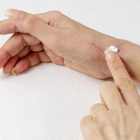 Die rechte Hand von einer Frau liegt seitlich angewinkelt auf einer weißen Unterlagen. An ihrem Handgelenkt hat sie einer Narbe. Mit ihrem linken Zeigefinger verteilt sie Creme auf der Narbe.  (Foto: AdobeStock/BarTa)
