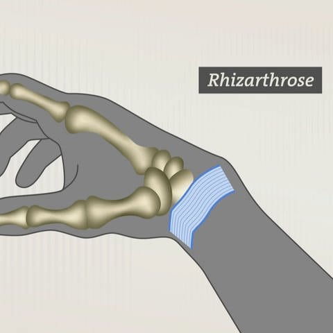 Grafik Rhizarthrose (Foto: SWR)