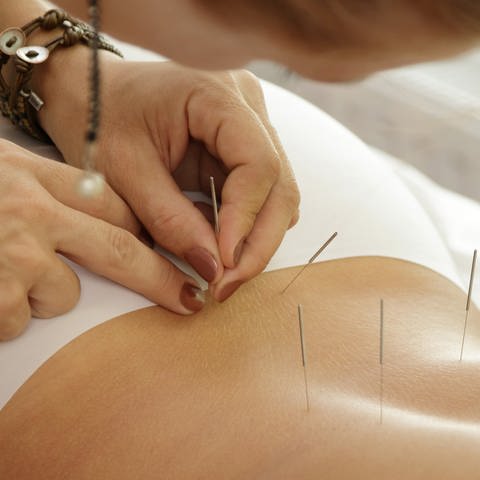 Eine Frau setzt Akupunkturnadeln in den Rücken einer Frau. Diese liegt mit dem Bauch auf einer Liege. (Foto: AdobeStock/blackday)