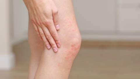 Eine Hand krazt sich am Knie: Ein geröteter, fleckiger Hautausschlag ist zu sehen. Es handelt sich um Nesselsucht. (Foto: Colorbox/ 56499162 Andrii)