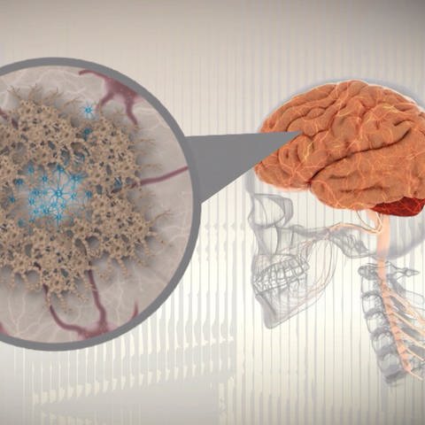 Abbildung des Gehirns - was passiert bei Alzheimer und welche Erfolge sprechen neue Medikamente? (Foto: SWR)