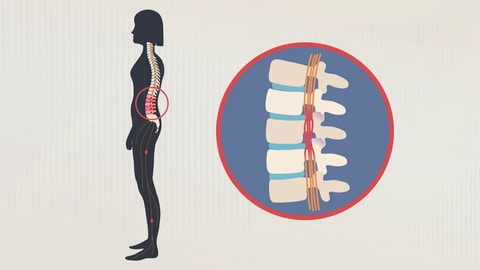 Die Graphik zeigt einen Menschen im Querschnitt, die Wirbelsäule ist farblich hervorgehoben. Im Lendenwirbelbereich ist sie rot gefarbt, dort wo die Rückenschmerzen am stärksten sind. Rechts davon zeigt eine Blase einen vergrößerten Ausschnitt der Wirbelsäule, hier wird der verengte Wirbelkanal mit den eingklemmten Nerven des Rückenmarks besonders deutlich. (Foto: SWR)