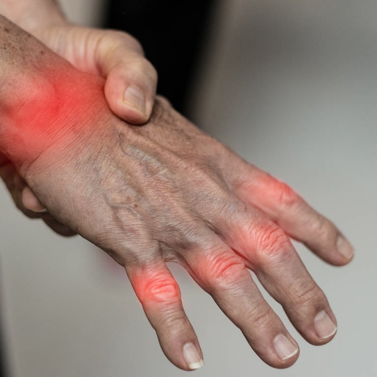 Ein älterer Mensch mit Gicht streckt seine Hand aus. Die durch einen Gichtanfall schmerzenden Gelenke sind rot markiert. Gichtknoten sind noch keine zu sehen. (Foto: Adobe Stock)