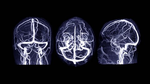 Drei verschiedene Bilder eines Gehirns mittels Magnetresonanz-Venographie des Gehirns für Anomalien im venösen Abfluss des Gehirns. (Foto: Adobe Stock, Adobe Stock/samunella)