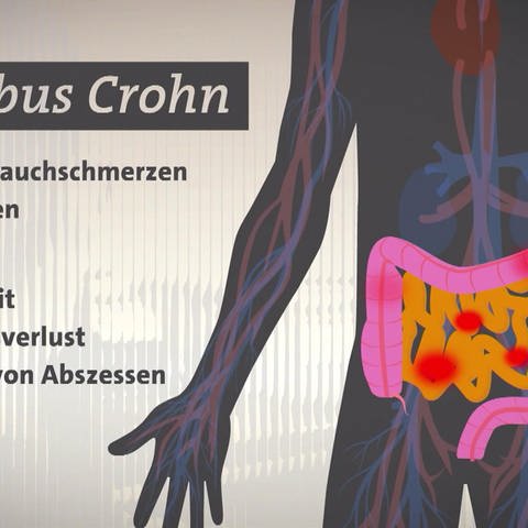 Morbus Crohn (Foto: SWR)