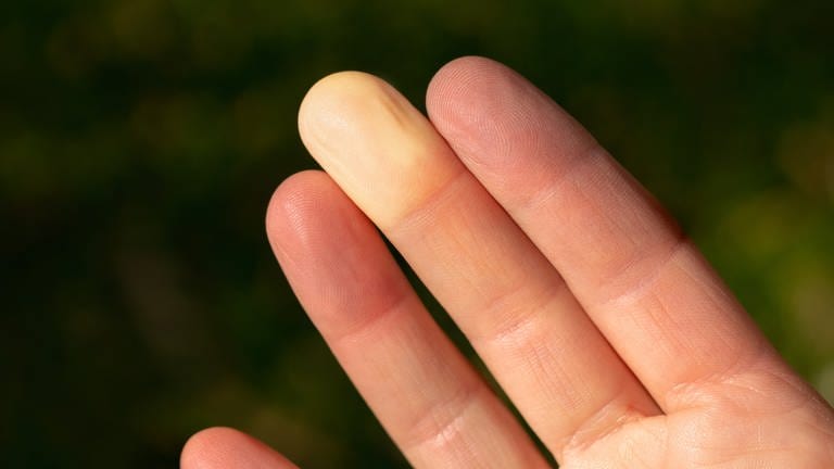 Hand, eine der Fingerkuppen ist ganz weiß, wie bei einer Leiche. Wie gefährlich ist das Raynaud-Syndrom? Was hilft? (Foto: Adobe Stock, Adobe Stock | Petra Richli)