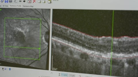 Computerbild: Blick in das Innere des menschlichen Auges, das an einer altersbedingten Makuladegeneration erkrankt ist. (Foto: SWR)