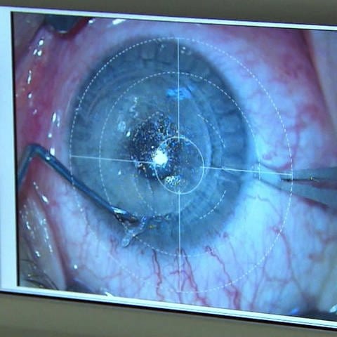 eine Laser-OP am Auge (Foto: SWR)