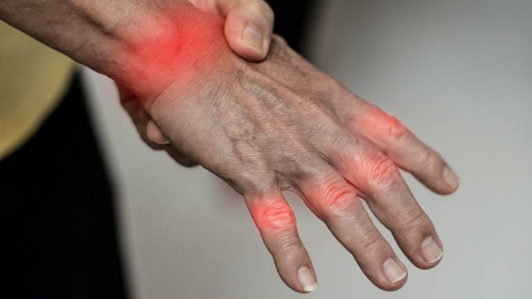 Ein älterer Mensch mit Gicht streckt seine Hand aus. Die durch einen Gichtanfall schmerzenden Gelenke sind rot markiert. Gichtknoten sind noch keine zu sehen.
