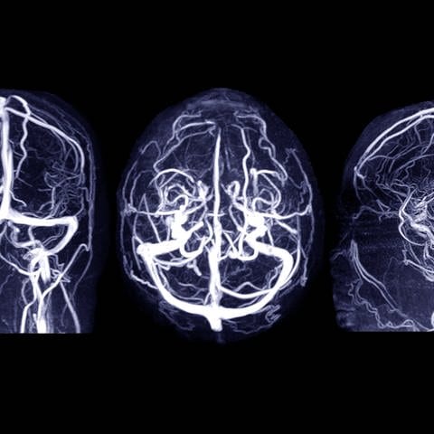Drei verschiedene Bilder eines Gehirns mittels Magnetresonanz-Venographie des Gehirns für Anomalien im venösen Abfluss des Gehirns.