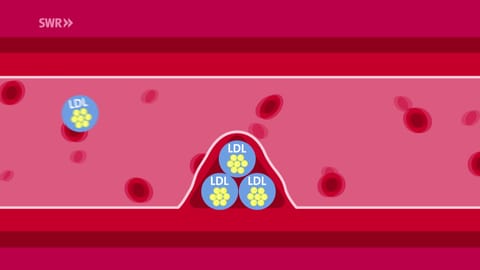 Die Graphik zeigt einen Querschnitt durch eine Blutbahn. Ein Komplex aus gelben Cholersterinmolekülen und den blauen LDL-Transportproteinen hat sich an der Gefäßwand abgesetzt und verkleinert den Durchgang für die Blutkörperchen. Dadurch steigt das Risiko an einer Herzkreislaufkrankheit zu erkanken.