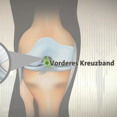Grafik, die anzeigt, wo das Kreuzband im Knie verläuft. Wird das Knie falsch belastet, kann das Kreuzband reißen. (Foto: SWR, Picture Alliance)