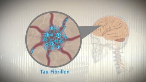 Skizze Tau-Fibrillen im Hirn