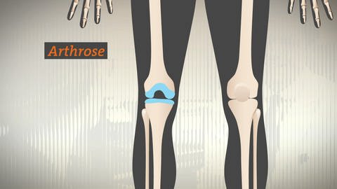 Abbildung der Knorpelschicht im Kniegelenk