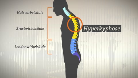 Grafik einer Person mit eingezeichneter Wirbelsäule. Beschriftung: Halswirbelsäule (oben), Brustwirbelsäule (mitte), Lendenwirbelsäule (unten). Person hat einen Rundrücken (Hyperkyphose)