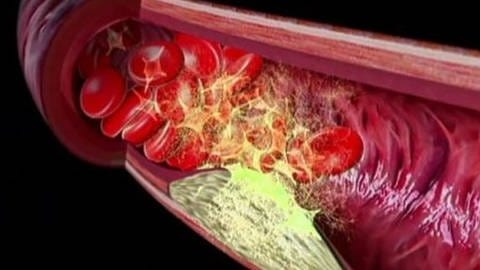 Computergrafik: In der Blutbahn angesammeltes Cholesterin verstopft das Blutgefäss, die Blutkörperchen können nicht mehr fließen